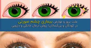 بیماری چشم صورتی چیست؟ + روش پیشگیری و درمان خانگی و دارویی
