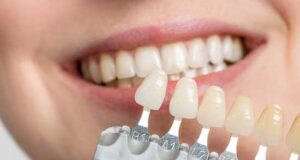 مزایای ایمپلنت نسبت به روکش