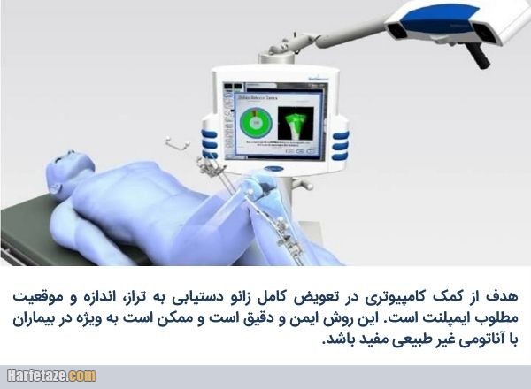 مزایای استفاده از ناوبری کامپیوتری در قرار دادن پروتز زانو
