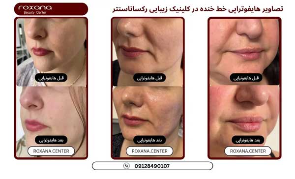هایفوتراپی