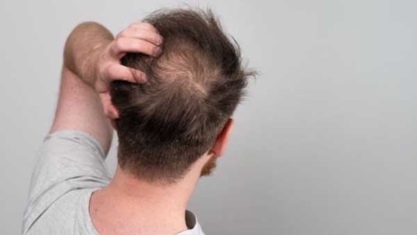 جلوگیری از ریزش مو 4 نقش پزشک در کنار استفاده از شامپو