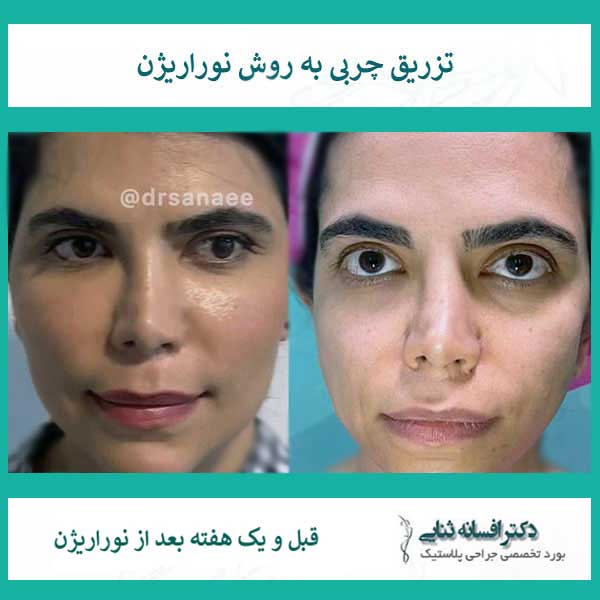 روشهای غیرجراحی رفع تیرگی زیر چشم با تمرکز بر نوراریژن 3 رفع تیرگی زیر چشم