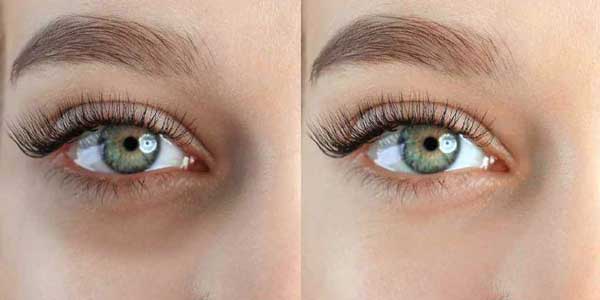 روشهای غیرجراحی رفع تیرگی زیر چشم با تمرکز بر نوراریژن 2 تیرگی و سیاهی زیر چشم