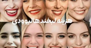 علت لبخند زیبای بازیگران سینما؛ لمینت یا کامپوزیت؟