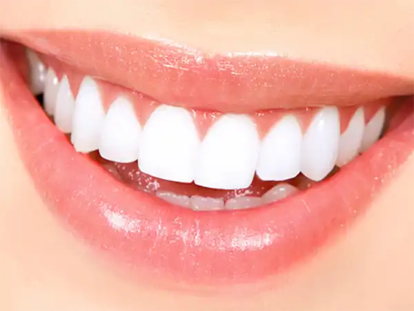 داشتن لبخندی زیبا با لمینت یا کامپوزیت؟