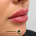 تزریق فیلر؛ معجزه جوانسازی طبیعی و راز انتخاب بهترین دکتر تزریق فیلر