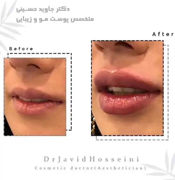 نمونه کار تزریق فیلر به لب